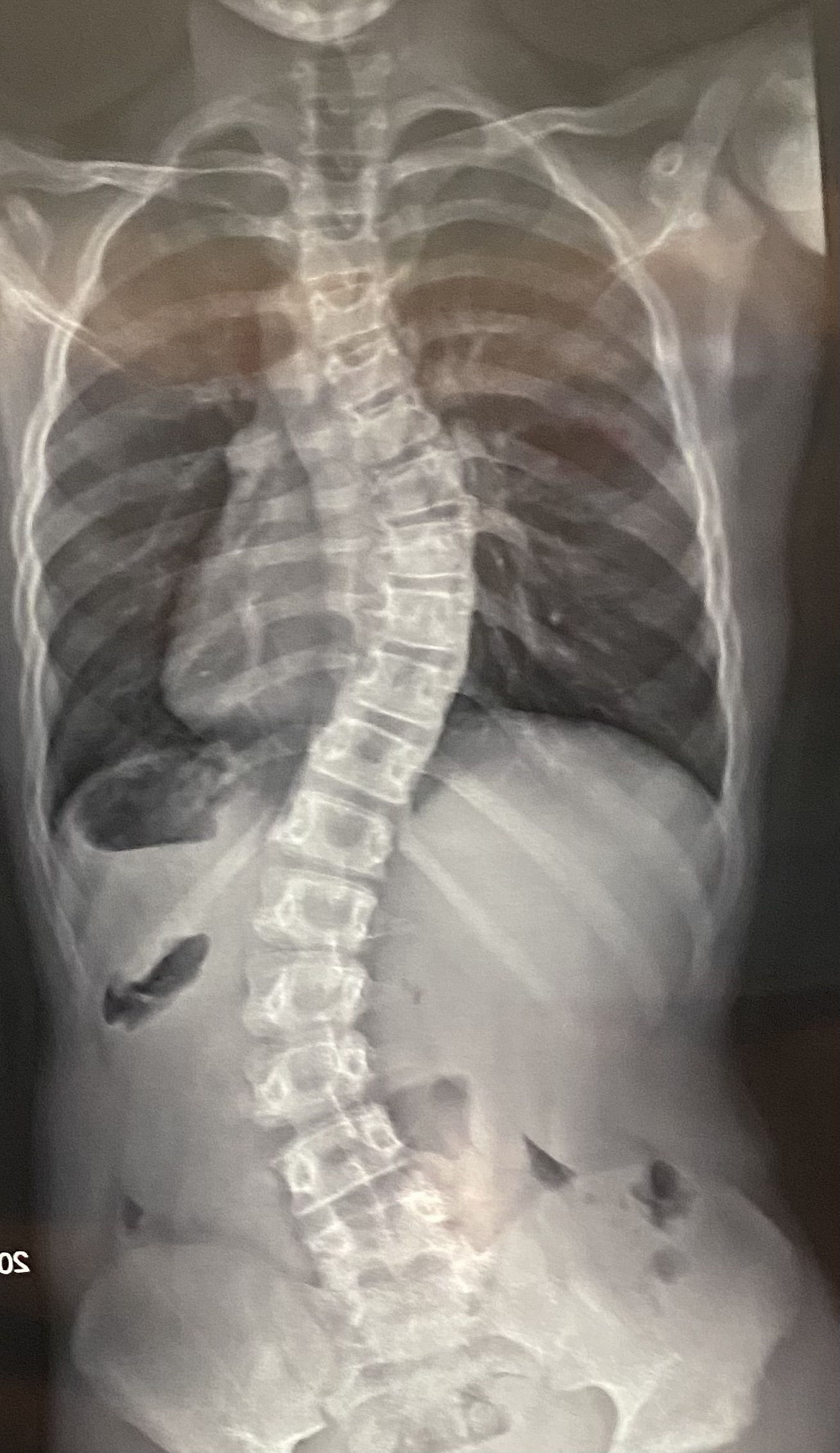 Scoliose pédiatrique sévère – Les Pas Pareils